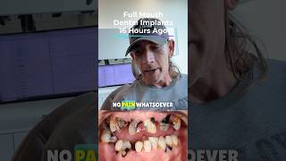 🤕 Do Full Mouth Dental Implants  Allon4 HURTdentalimplant [upl. by Dnomed422]