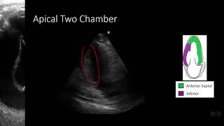 PointofCare Echo Regional Wall Motion Abnormalities [upl. by Montagna]