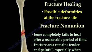 Fracture Healing Part 1  Everything You Need To Know  Dr Nabil Ebraheim [upl. by Nawyt]