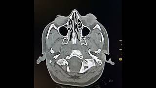 Otitis media and acute mastoiditis [upl. by Zetrom]