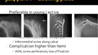 Proximal Humerus Fractures by Dr James Churchill [upl. by Hugibert]