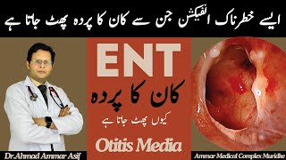 Otitis Media  Causes Symptoms Risk Factors Treatment  kan ka parda phat jana ka ilaj  DrAmmar [upl. by Acnairb]