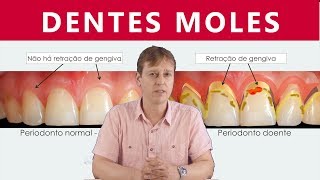 Dentes Moles  Mobilidade do Dente sem Periodontite ou Retração de Gengiva [upl. by Etak]