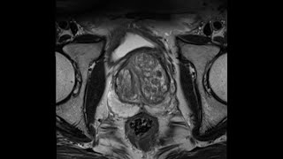 Introduction to Prostate MRI and PIRADS Approach and Principles [upl. by Adierf697]