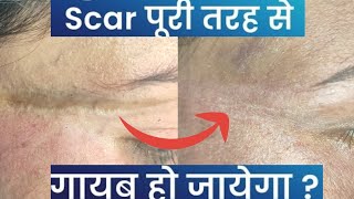 Scar revision surgery of a lady from MP Scar revision surgery in Ranchi scar treatment scar [upl. by Alleon]