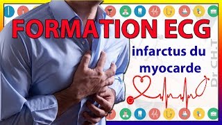 ECG de linfarctus du myocarde [upl. by Hays]