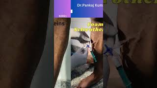 varicose veins treatment Foam Sclerotherapy treatment for varicose veins varicoseveins [upl. by Noteloc]