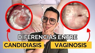 Diferencias entre candidiasis y vaginosis  Dr William Guerrero [upl. by Cherish]