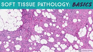 Basic Soft Tissue Pathology Cases Explained by a Sarcoma Pathologist [upl. by Calendre]