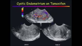 Ultrasound of the Endometrium [upl. by Nuzzi]