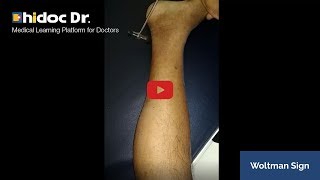 Woltman Sign Video  Medical Cases Video only on Hidoc [upl. by Scarrow]