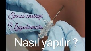 Spinal anestezi Belden uyuşturma nasıl yapılır Spinal Anestezi [upl. by Zemaj]