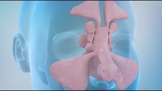 Sinusitis and Sinus Surgery Explained Balloon Sinuplasty and Endoscopic Sinus Surgery [upl. by Keviv760]