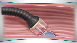 Learn About an Endoscopic Mucosal Resection [upl. by Notnroht]