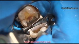 Onlay preparation on tooth 36 with distal margin coronal relocation [upl. by Tristis]