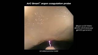 Arc Smart™ Argon Coagulation Probe  Clinical Video [upl. by Ydok]