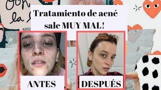 SKINCARE PARA ACNÉ MI EXPERIENCIA 7DÍASDE [upl. by Ecinev]