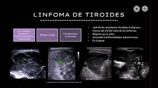 Radiología en 5 minutos Linfoma de tiroides [upl. by Llednav]