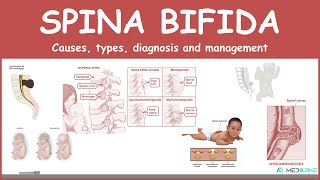 Spina bifida Types myelomeningocele meningocele occulta  causes symptoms diagnosis treatment [upl. by Weitman]