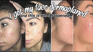 DERMAPLANING BEFORE AND AFTER with footage [upl. by Elreath]