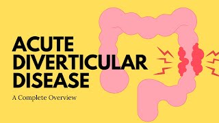 Management of Acute Diverticular Disease  A Complete Overview [upl. by Eixirt541]