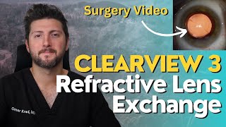 Refractive Lens Exchange RLE Surgery with the Clearview 3 Lens [upl. by Ayikahs949]