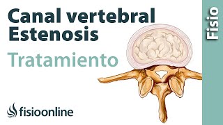 Estenosis de canal vertebral lumbar  Qué es y cómo se trata [upl. by Dyan949]