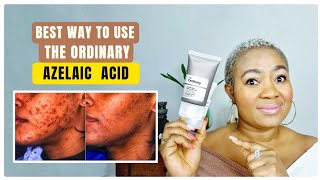 The Ordinary Azelaic Acid Suspension 10 Review Best Way To Use For Clear Skin [upl. by Assyn]