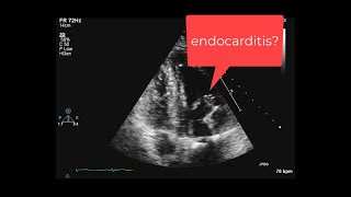 Endocarditis after mitral valve reconstruction [upl. by Bradshaw]