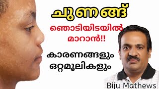 ശരീരത്തിലെ ചുണങ്ങ് അതിവേഗം മാറാന്‍ ചില ഒറ്റമൂലികള്‍  Natural remedies for tinea versicolor [upl. by Prady]