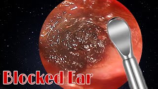 BIGGEST Ear Wax Difficult Removal  EP3  Doctor Anh [upl. by Zelle34]