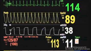 Bronchospasm 2  Patient Monitor [upl. by Odareg]