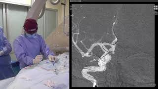 Transradial StentAssist Coil Embolization of an Anterior Communicating Artery ACOM Brain Aneurysm [upl. by Anialram]