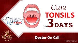 Quick Home Remedies for Tonsillitis in 3 Days  Doctor On Call [upl. by Ahsened38]