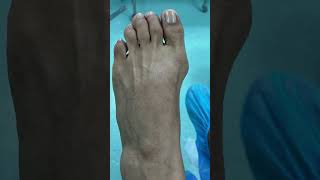 CIRUGÃA MÃNIMAMENTE INVASIVA DEL HALLUX VALGUS doctorjuancarlosalbornoz HALLUXVALGUS [upl. by Arratahs899]