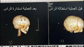 عملية اعادة تشكيل الجمجمة لفك التحام درزات مبكر [upl. by Jamesy]