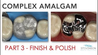 Complex Amalgam  Finishing amp Polishing  Part 3 [upl. by Unders]