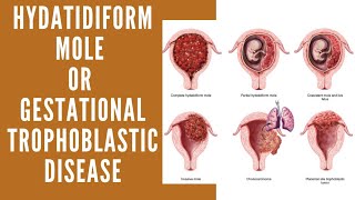 Hydatidiform Mole  Vesicular Mole  Molar Pregnancy  Gestational Trophoblastic Disease [upl. by Ecnerwaled]