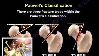 Femoral Neck Fracture Classification  Everything You Need To Know  Dr Nabil Ebraheim [upl. by Yennep934]