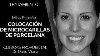 Carillas de Porcelana de la Miss España para Miss Universo [upl. by Roseline]