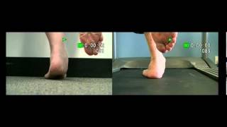 Positive Single Leg Heel Raise Test For PTTD [upl. by Ariahs383]