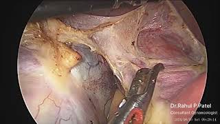 Fibroid Uterus with Dermoid Cyst [upl. by Faber576]