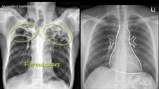 Chest x ray  Tuberculosis healed TB Inactive TB [upl. by Kcirredal65]