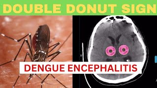 Double Doughnut Sign Dengue Encephalitis  CT or MRI Brain Findings in Dengue Encephalitis [upl. by Acemaj]