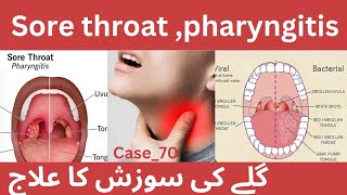 Sore throat pharyngitistheraputic amp non therapeutic treatment  گلا خراب، کھانسی ،زکام کا علاج [upl. by Arin]