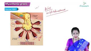 Myasthenia Gravis Part 1 Hindi  Internal Medicine [upl. by Hardin]