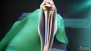 Precice Tibia Lengthening Surgical Animation [upl. by Eitisahc]