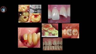 Conservative dentistry  introduction حشوات الأسنان  مقدمة [upl. by Bradstreet]