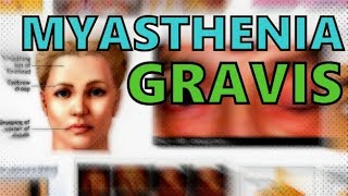 Myasthenia Gravis MADE EASY  Cause Symptoms Diagnosis and Treatment of MG  Animation [upl. by Halet]