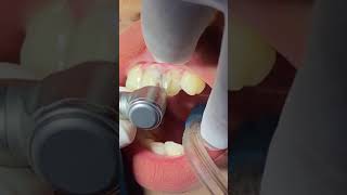 Scalingdentist dentalcare dental scaling scalingteeth [upl. by Ingeberg]